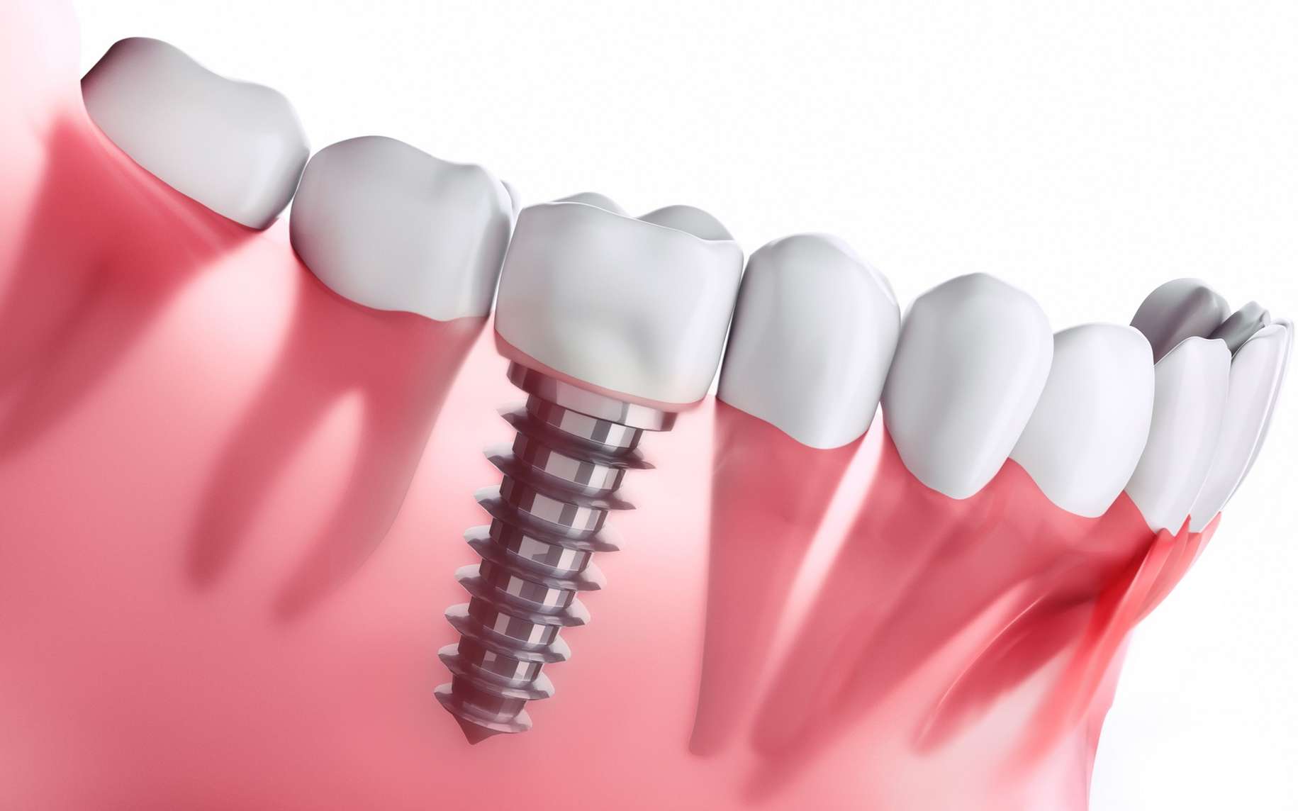 Solutions pour remplacer une dent manquante (dent provisoire/bridge/implant)